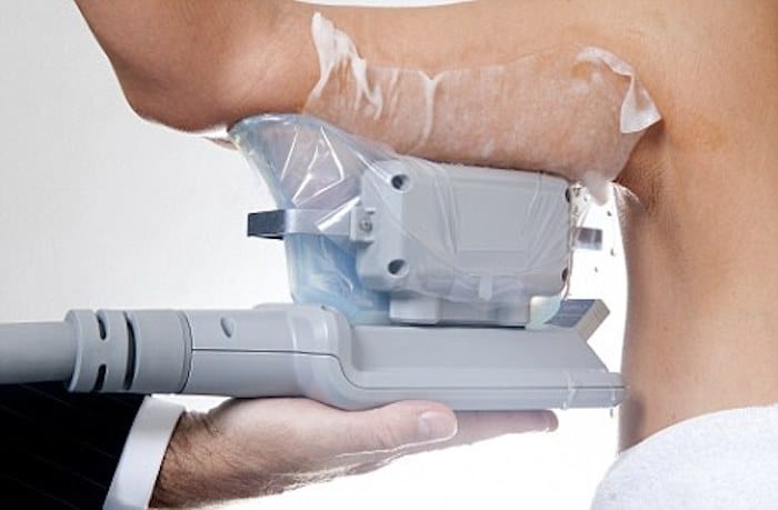 fat freezing arms Nuneaton