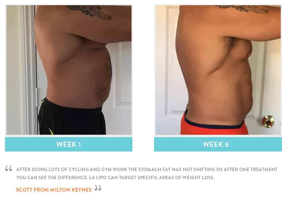 Before & After Stomach Fat Nuneaton