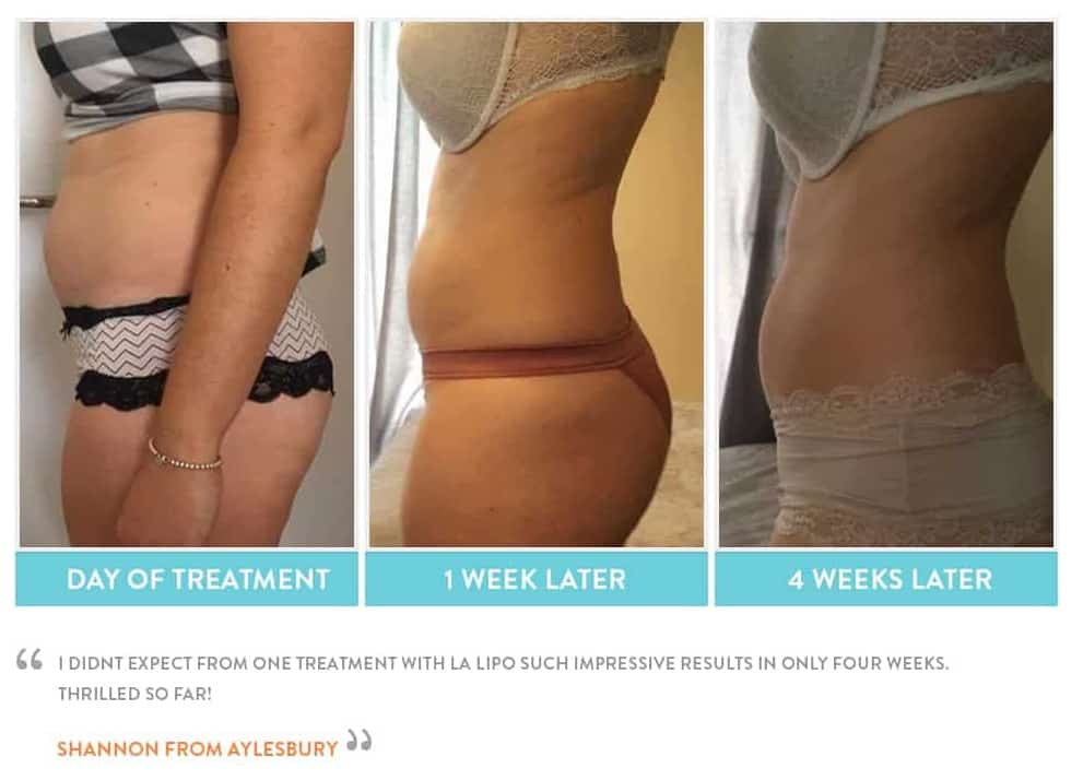before, Cryolipolysis Nuneaton