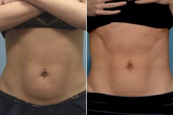 body sculpting FAQs Nuneaton