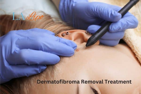 Dermatofibroma Removal Treatment Nuneaton