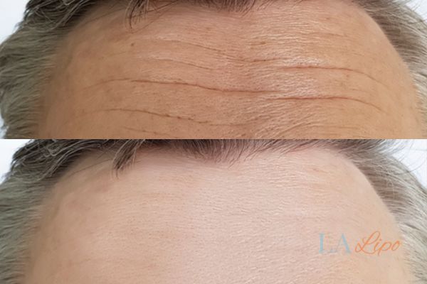 HIFU before and after