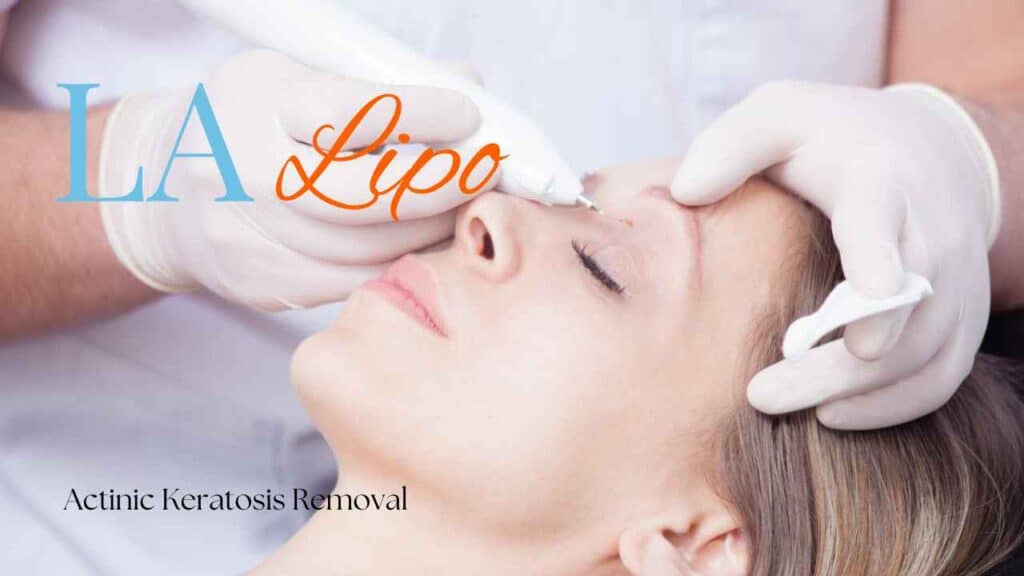 actinic keratosis removal Nuneaton