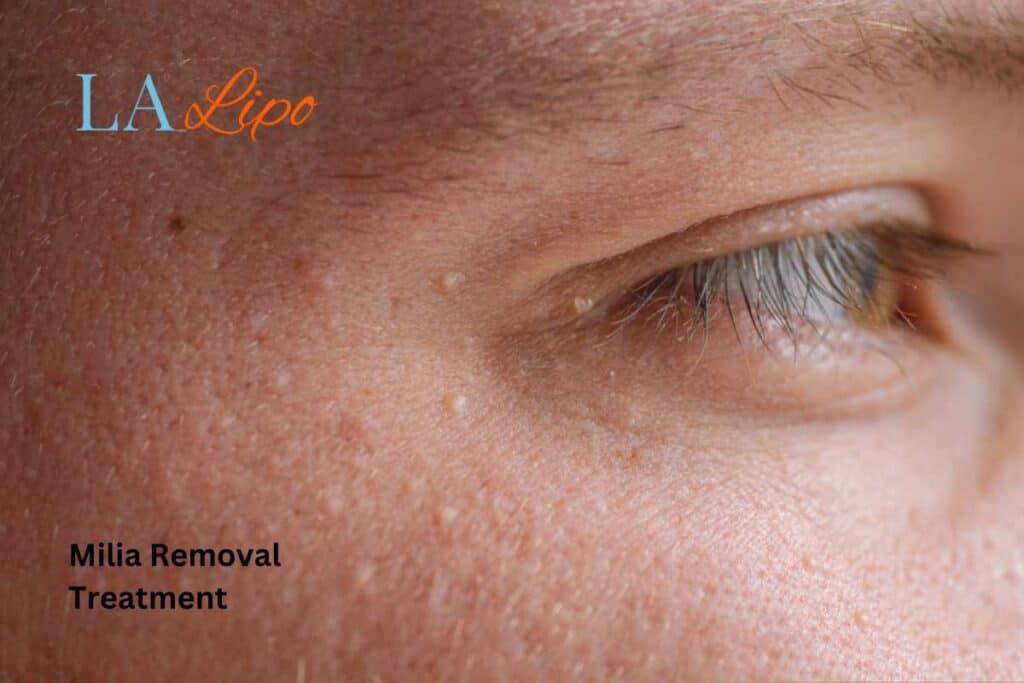 Cryopen Milia Removal: Is It the Easiest and Safest Option ?