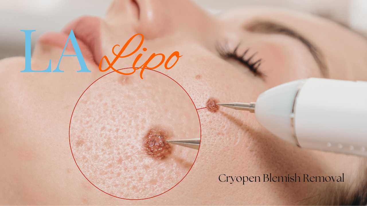 cryopen blemish removal Nuneaton Contact our team today!