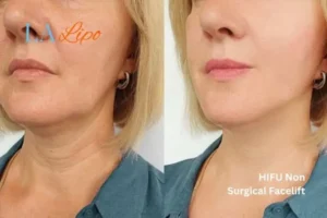 hi-fu for wrinkles Nuneaton before and after results