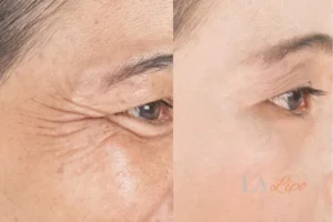 Before and after results of woman - HI-fu wrinkles reduction treatment Nuneaton
