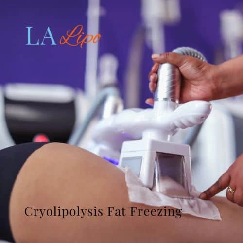 fat freezing - Cryolipolysis Nuneaton
