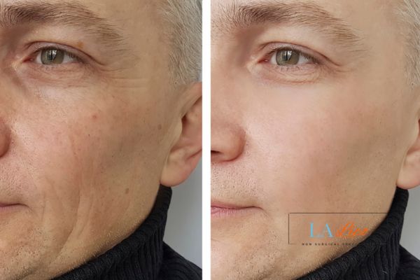 See the amazing results of Morpheus8 Treatment Nuneaton!