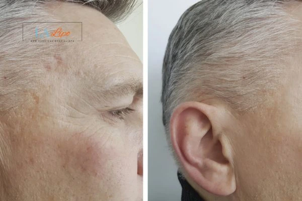 Mens Before & After Morpheus 8 Results Nuneaton