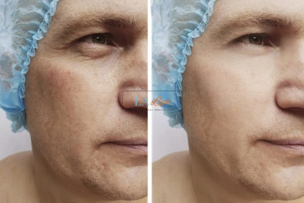 Before and after Morpheus 8 Results Nuneaton