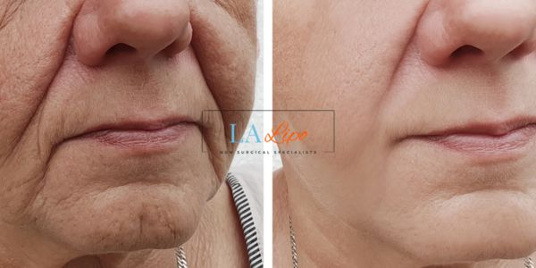 Older lady deeper wrinkle reduction - LA LIPO Morpheus 8 Results Nuneaton