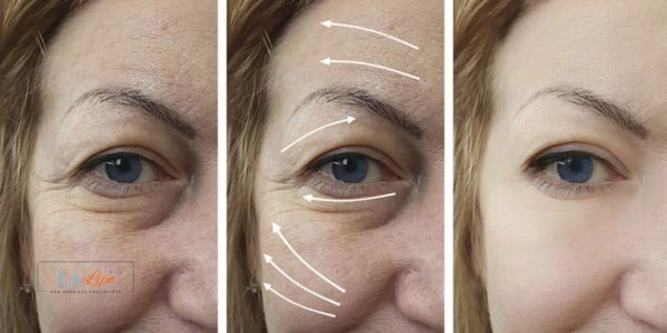 Amazing eye lift Morpheus 8 results Nuneaton