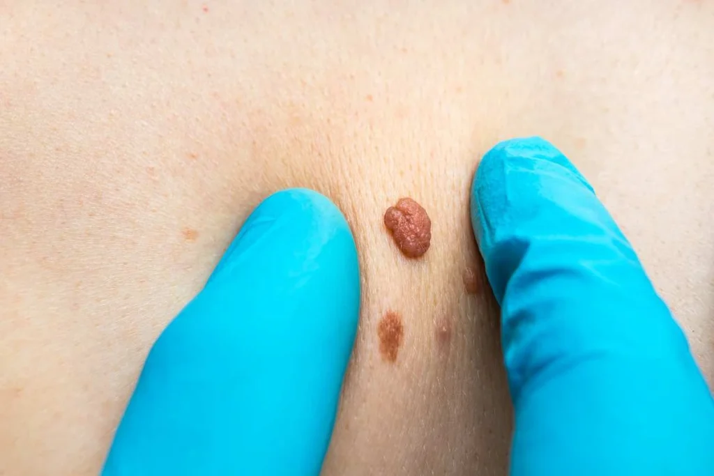 LA LIPO Cryopen Lesion Removal Prices Nuneaton